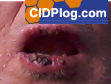 IVIG lip-blister IVIG lip-scab adverse reaction